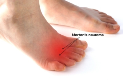 Facts About Morton’s Neuroma