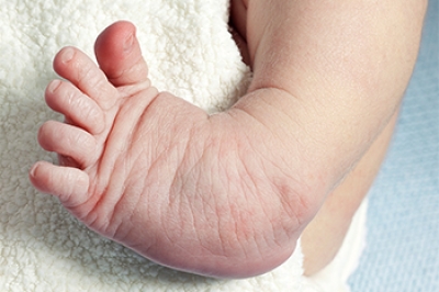 Types of Congenital Foot Conditions