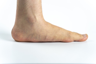 Types and Foot Dynamics of Flat Feet